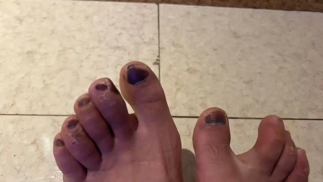 一登山者独登慕士塔格峰遭遇惊心经历：两次坠崖捡回一条命，脚趾冻伤至今呈黑色