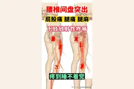 腰疼、臀部及下肢疼痛，该如何治疗？为您指明方向图片