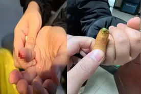 【杏林春暖】九江市中医医院运用中西结合成功治疗手指末节不全离断伤图片