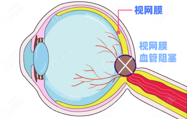眼睛出现这4表现，可能是脑血栓找上门了，医生：千万不可当小事