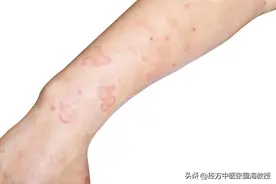 慢性荨麻疹，简单四步，让你轻松告别风团瘙痒，荨麻疹不再扰！图片