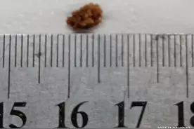 天老爷，排出好大一颗结石。结石痛估计和生孩子差不多痛吧？图片