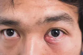 眼科麦粒肿和散粒肿的民间疗法图片