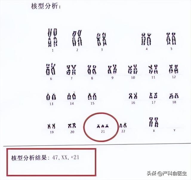 唐筛提示高风险怎么办？产科医生告诉你真相。