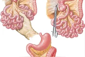 饭后剧烈运动，居然会导致肠管扭转？不及时复位要切肠子！图片