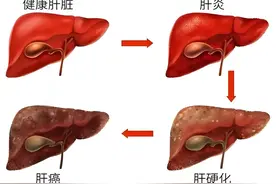肝硬化：了解病因、症状与科学防治图片