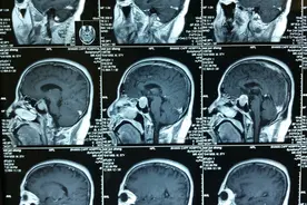 内窥镜辅助下，经蝶垂体瘤切除手术图片