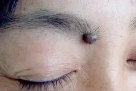 【爱美•科普】“痣”，绝对不可以轻视图片