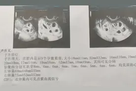 怀九胞胎女子已进行第二次减胎手术，最终留下两胎图片