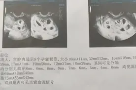 怀九胞胎女子已进行第二次减胎手术，最终留下两胎图片