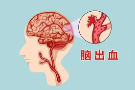 越来越多的人脑出血去世！医生含泪苦劝：这5件事，再发也要戒掉图片