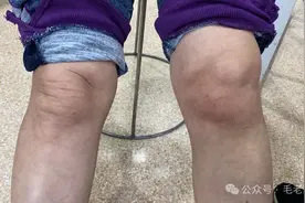 风湿关节炎别再吃止痛药！我用一副中药，治好了上百例风湿关节炎图片