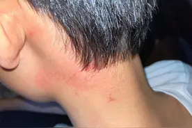 惊悚！密室逃脱，13岁上海男孩遭遇“逃命时刻”！铁门砸落“卡脖”，满身伤伤伤图片