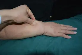 上肢淋巴水肿的早期迹象和预防方法！图片