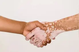 白癜风的秘密：白癜风久治不愈，可能是甲状腺出了问题图片