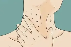 【一院技术】皮肤疣不可怕，济宁市第一人民医院治“疣”有了“新武器”，温热治疗仪让“疣”愁不再来图片