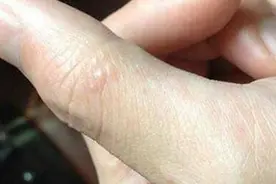 手上长小水泡，瘙痒还脱皮，能根治吗？医生：3个方法可不复发图片