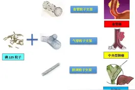 【健康科普】放射性粒子植入治疗肿瘤健康宣教图片