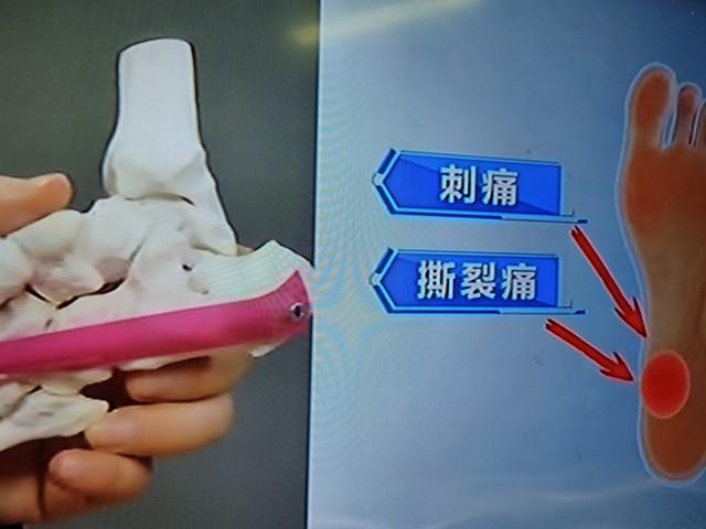 员工脚痛请假当天走 1.6 万步，公司火速开除，法院判了：赔 11 万，这错在哪？