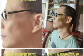 打卡祛斑看效果图片