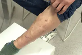 52岁花一个月工资，做了静脉曲张微创手术，后悔没早点听女儿的话图片