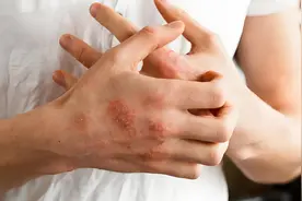 医生研究发现：患上湿疹的人，多有4个共性，希望你一个不占图片