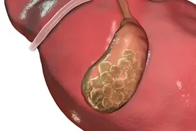 胆囊炎伴胆结石，2味药，一边化石，一边祛湿，双管齐下图片