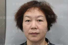 50岁不顾反对做眼袋手术，不住院不缝针，熬过恢复期，7天长这样图片