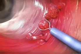 肠息肉来临时，5个早期症状，哪怕出现一个也要尽早检查！图片