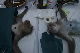 全球首例换头手术完成，换头后成功苏醒，为何之后又实施安乐死？图片