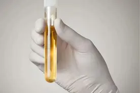 每次体检，为什么都要求留「晨尿」？图片