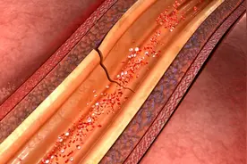 冠心病患者“低压”不要低于这一标准！血压低，三大原因得注意图片