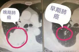 警惕恶性：磨玻璃肺结节出现这4大特征，不可大意，以防肺癌！图片