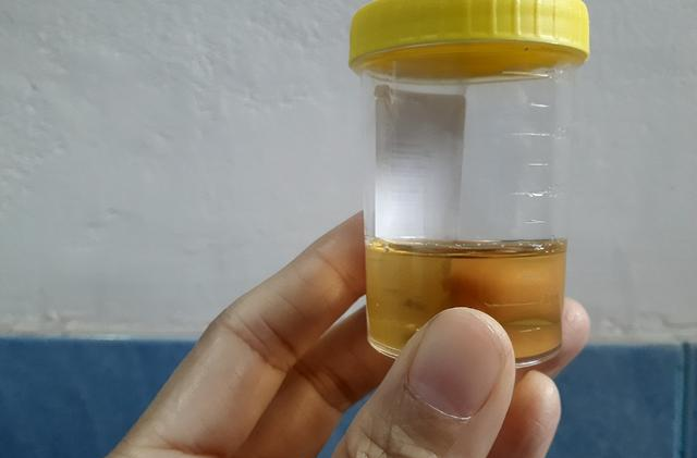 运动后，肌肉竟然溶解了！医生：再这样运动，小心肾衰！