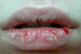 嘴唇干裂、起皮？保温杯里加2味，补阴又补阳，滋润一整个冬天图片