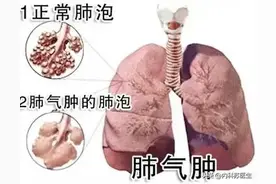布地奈德福莫特罗与噻托溴铵都可用于慢阻肺，二者有何区别？图片