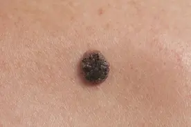 记住黑色素瘤的ABCDE！早发现，早治疗！图片