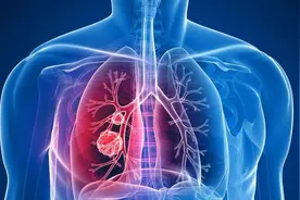 切掉一个肺叶，对肺功能有多大影响？还能恢复？图片