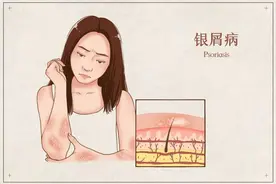 银屑病丨反复发作的牛皮癣，偏爱抽烟喝酒、压力大图片