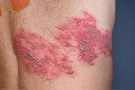 带状疱疹，疼得咬牙切齿，痛得死去活来，一个廉价中成药可清除图片