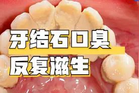牙结石口臭反复滋生怎么办？原来问题出在这！只需3步就搞定！图片