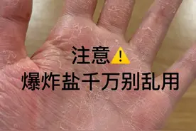 注意爆炸盐千万别乱用！别等手掉皮了才后悔！图片
