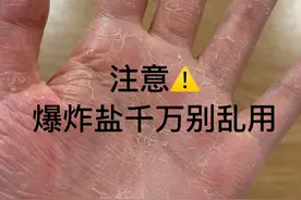 注意爆炸盐千万别乱用！别等手掉皮了才后悔！图片