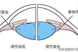 近视和老花会同时存在？华西专家说，正常，忙和穷也同时存在…图片