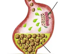 经常反酸、烧心，是怎么了？图片