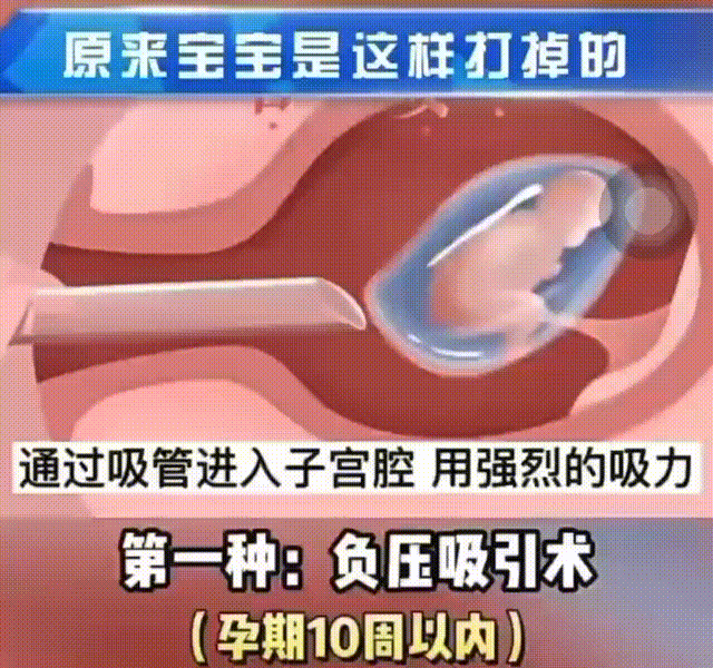 #健康素养提升V计划# 【#人流#只需要几分钟，然后发生了什么？】