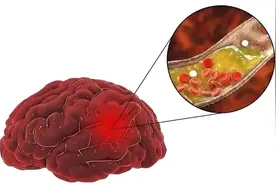 3个中成药降血黏度，溶血栓，调微循环，缩小脑梗面积，保护神经图片