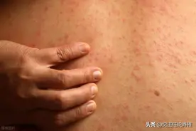 体内有病，皮肤先知？皮肤出现这4种异常信号，别以为只是发炎图片