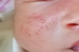 3分钟带您看懂婴儿常见皮疹！图片
