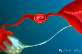 宫外孕切除一侧输卵管，不孕3年，没想到还能自怀当妈妈！图片